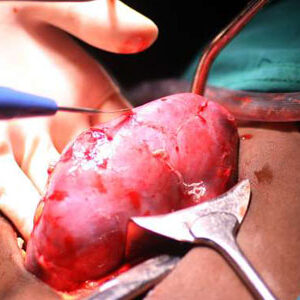 Human Kidney For Sale