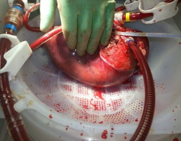 Human Liver For Sale 1 580x450