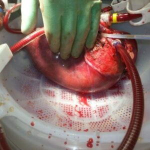 Human Liver For Sale